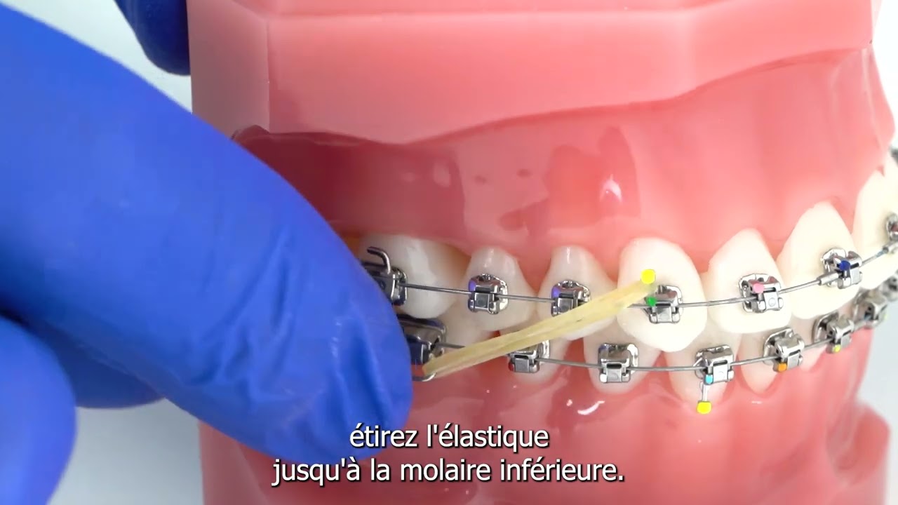 Comment poser des élastiques de Classe II en orthodontie | Technique avec multi-attaches (brackets)