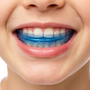 orthodontie_fonctionnelle
